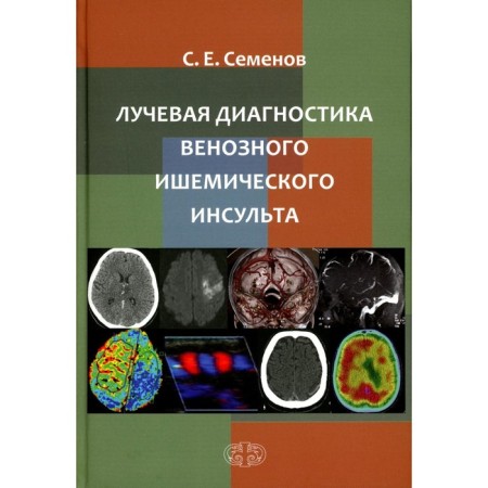 Radiation diagnosis of venous ischemic stroke. Semenov S.E.