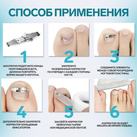 Corrector-fixer for an ingrown nail, size L, in a plastic case, silver color-1