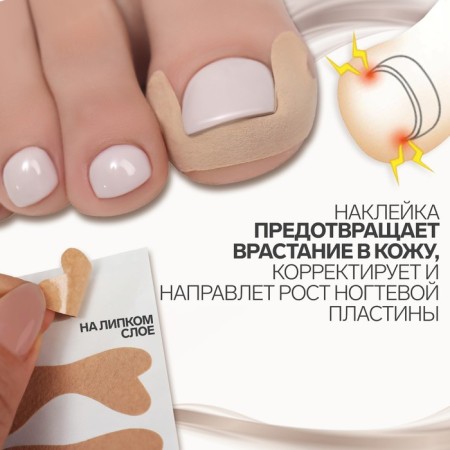 Stickers against ingrown nails, 6 pcs, 4.5 × 1.7 cm, beige color-1