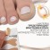 Stickers against ingrown nails, 6 pcs, 4.5 × 1.7 cm, beige color