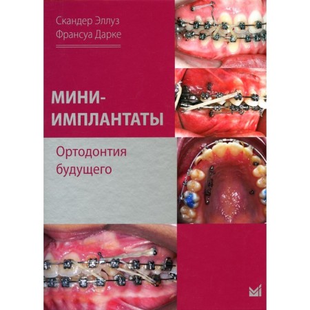 Mini-implants. Orthodontics of the future. Ellus S.