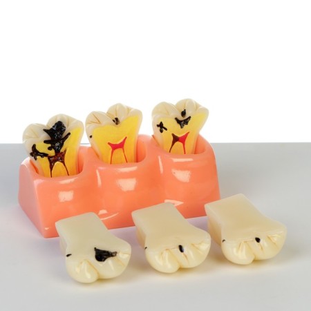 Layout "Building tooth, Diseases", 12*7*6cm-3