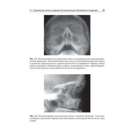 Otorhinolaryngology. under. Ed. Karpishche-3