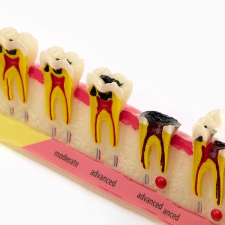 Matcage "Dental disease" in the context of 14*5cm-3