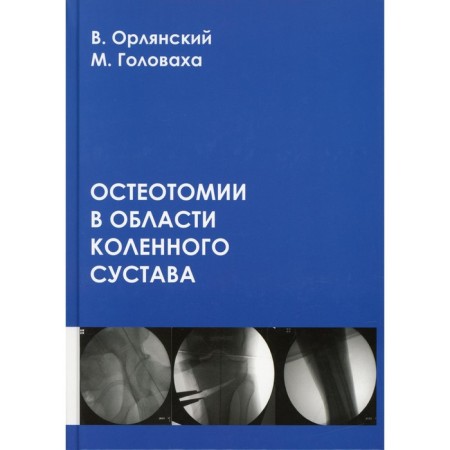 Osteotomy in the knee joint. Orlyansky V., Golovakha M.L.