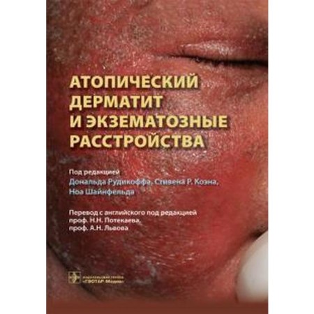 Atopic dermatitis and eccematous disorders