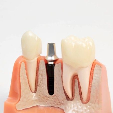 Mett "tooth structure" 9*6*9cm-2