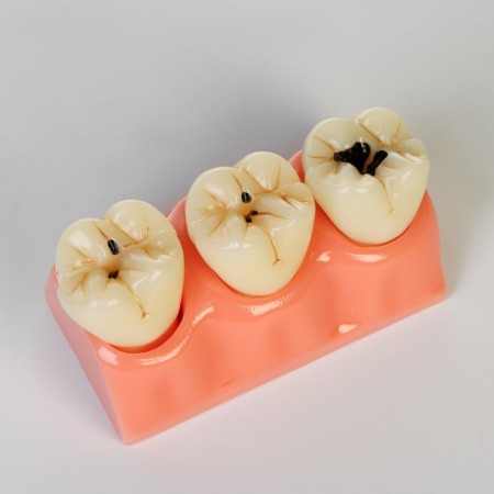 Layout "Building tooth, Diseases", 12*7*6cm-2