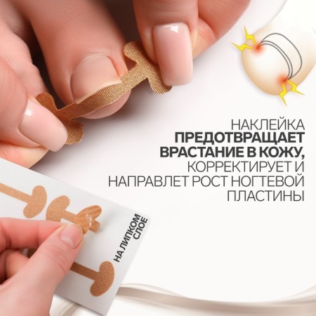 Set of stickers for correcting ingrown nails, 8 pcs, 5.2 × 2 cm, beige color-1