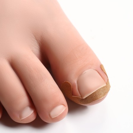 Set of stickers for correcting ingrown nails, 8 pcs, 5.2 × 2 cm, beige color-3