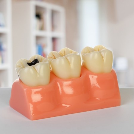 Layout "Building tooth, Diseases", 12*7*6cm-1