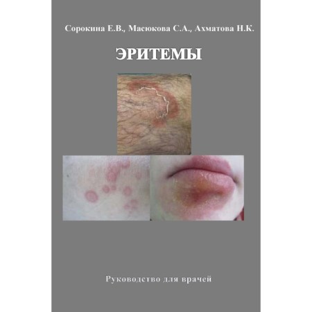 Erythema. Guide for doctors. Akhmatova N.K., Masyukova S.A., Sorokina E.V.