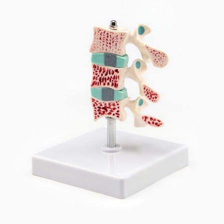 Matcage "spine in the context" 8*7cm
