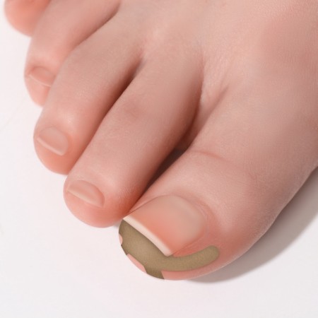 Set of stickers for correcting ingrown nails, 16 pcs, beige color-5