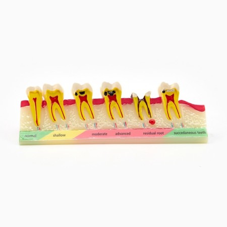 Matcage "Dental disease" in the context of 14*5cm-1