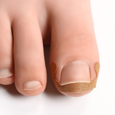 Set of stickers for correcting ingrown nails, 8 pcs, 5.2 × 2 cm, beige color-2