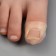 Protective covers for correction of ingrown nails, steam, 2.8 x 2 cm, the color is transparent